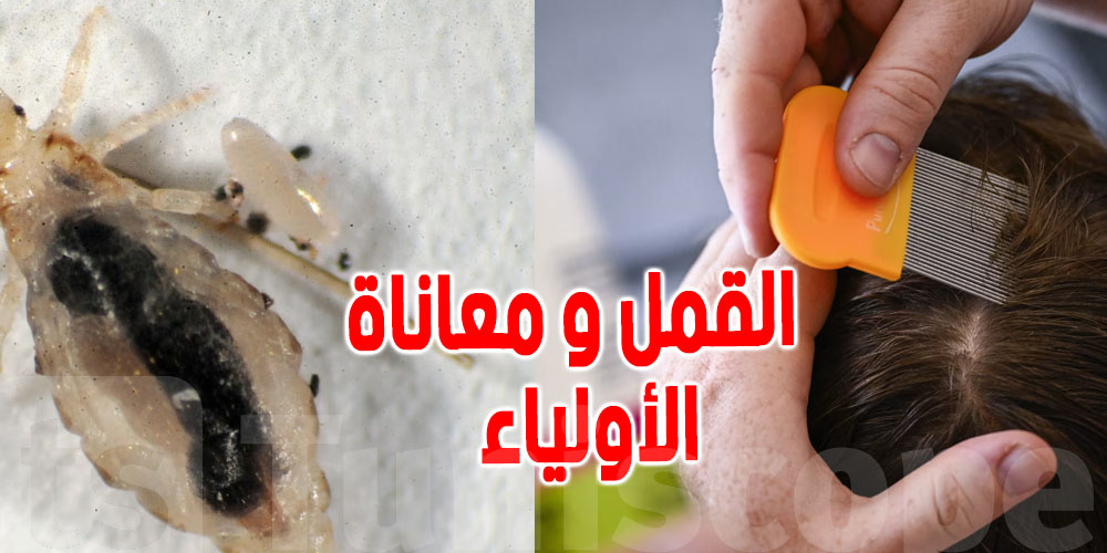 يهم الأولياء : من أين يأتي قمل الرأس و ماهي طرق التخلص منه ؟