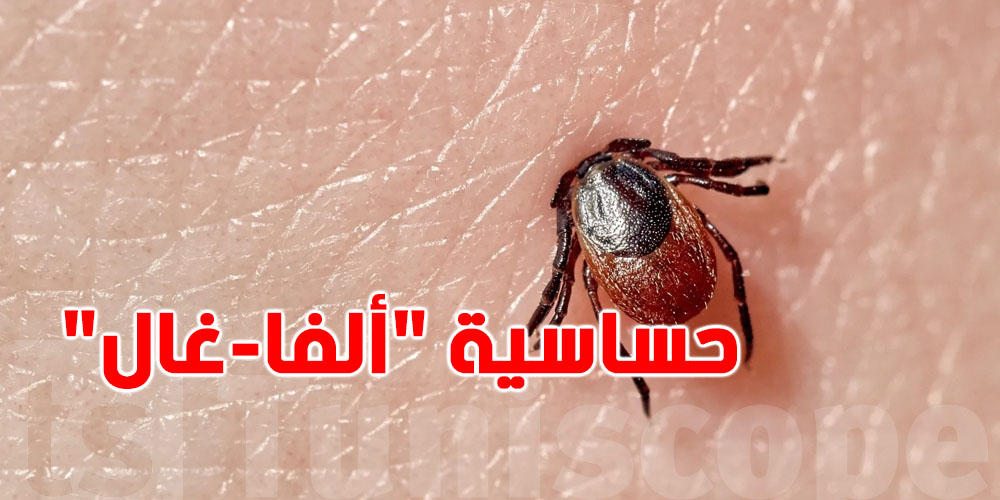 أعراض خفية وخطر كبير: كل ما يلزمك تعرفه عن حساسية ''ألفا-غال''