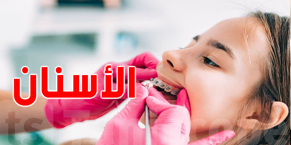 تونس : أنواع و أسعار تقويم الأسنان