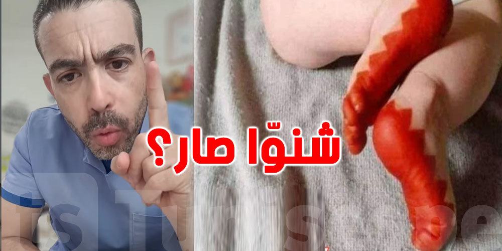 الدكتور محمد عيّادي يحذّر: طفل زعمة مات بسبب ''الحنّاء'' في طهوره