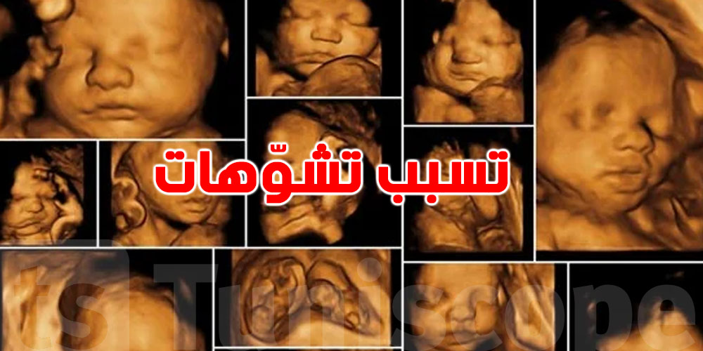 تحذير للحوامل.. مواد في منزلك قد تؤثر على تكوين وجه الجنين وتسبب تشوّهات!