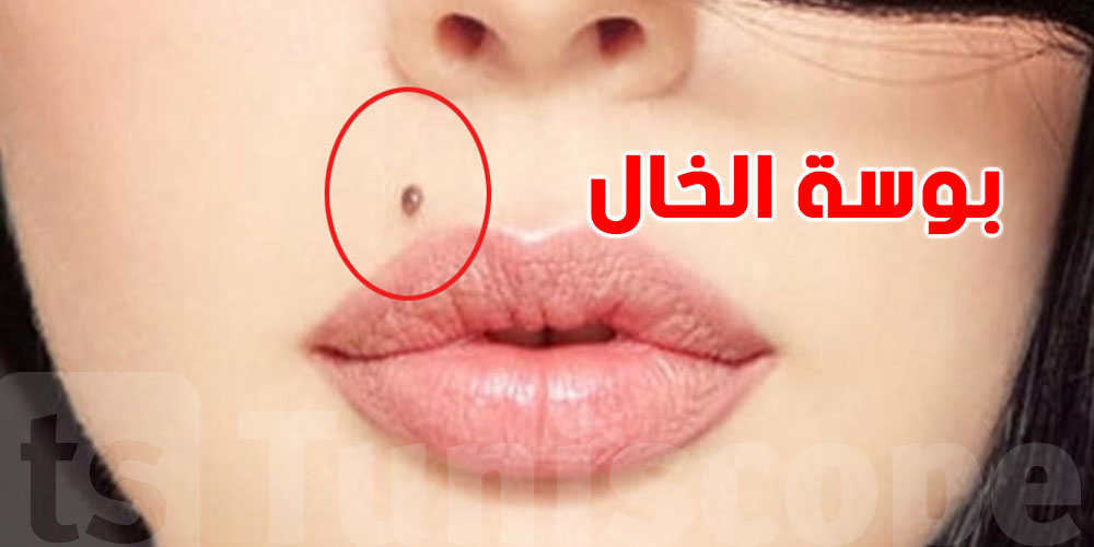 ''بوسة الخال'' شنيا حكايتها  وهل عندها علاقة بمرض السرطان؟...طبيب يوّضح