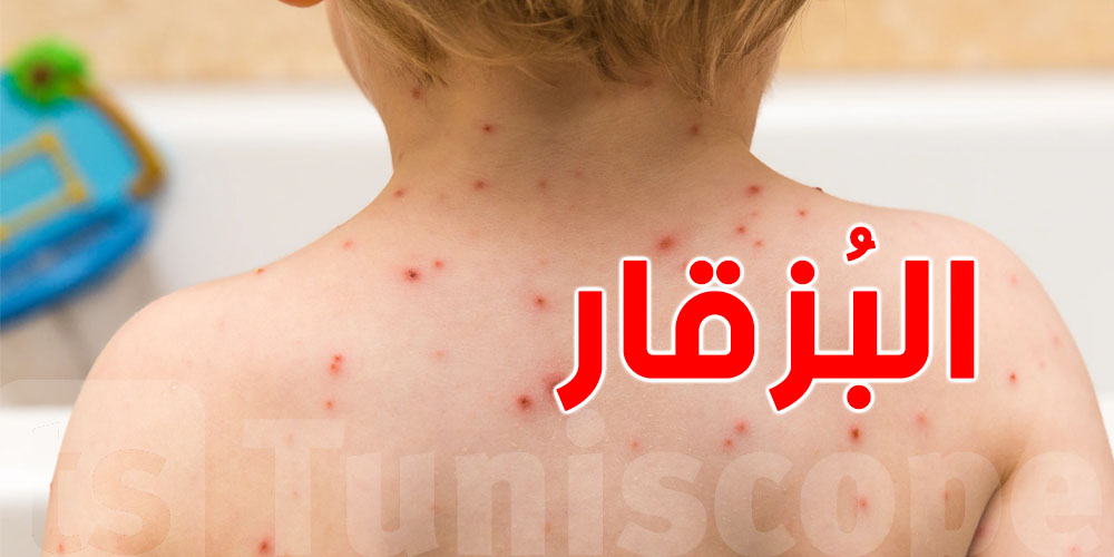 البوزقار: من أكثر الفيروسات إنتشارا حاليا في تونس