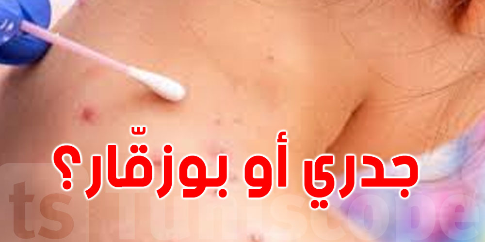 صفاقس: الفتاة المشتبه في إصابتها بالجدري قد تحمل مرض ''البوزقار''