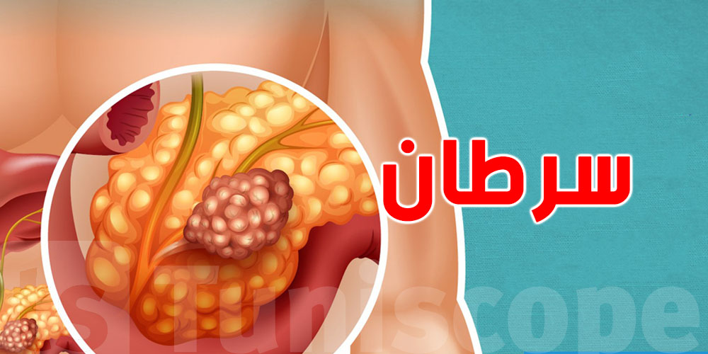 رّد بالك: 4 علامات تحذيرية تخبرك على هذا النوع من السرطان