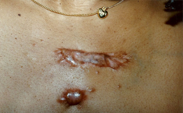 Une équipe de dermatologues 100% tunisiens, conçoit un traitement contre les cicatrices