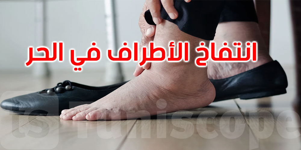 لماذا تنتفخ الأطراف مع ارتفاع الحرارة؟ أطباء يوضحون