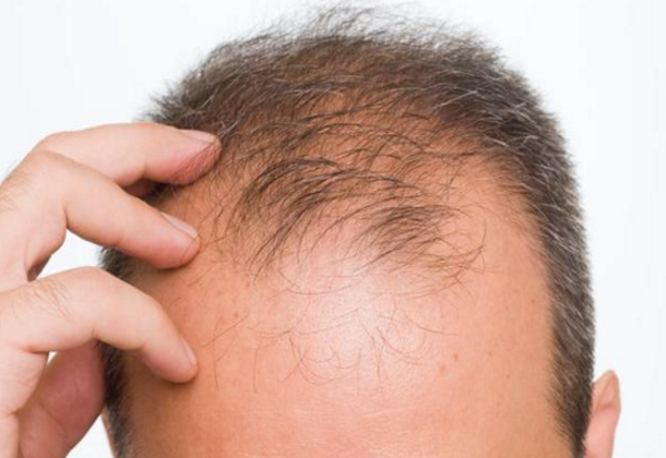 دراسة: الرجل الأصلع أكثر نضجاً وذكاء وصدقاً
