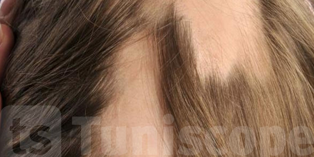 بشرى سارة لمرضى الثعلبة