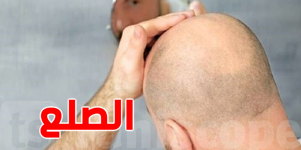 ثورة في علاج الصلع و تساقط الشعر : علماء يكشفون!