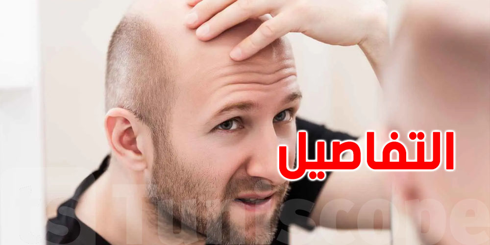 أمل جديد في علاج الصلع الوراثي