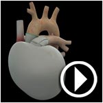 En vidéo : Détails de la première implantation d'un coeur artificiel français