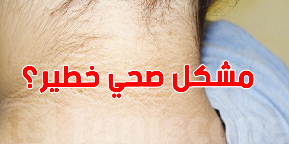 شنوّة السرّ ورا السواد في الرقبة؟ علامة تقلك عندك مرض ولا حاجة عادية