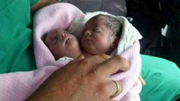 في حالة فريدة.. ولادة طفل برأسين في إدلب!