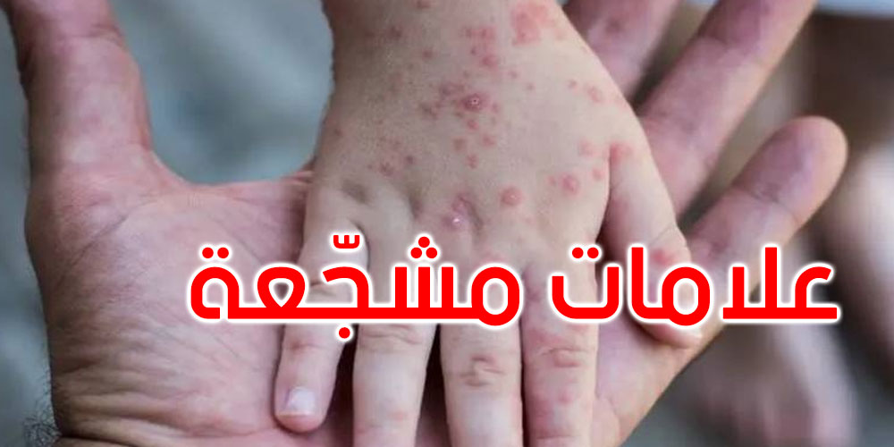 منظمة الصحة العالمية: أوروبا في الاتجاه الصحيح في مكافحة جدري القردة