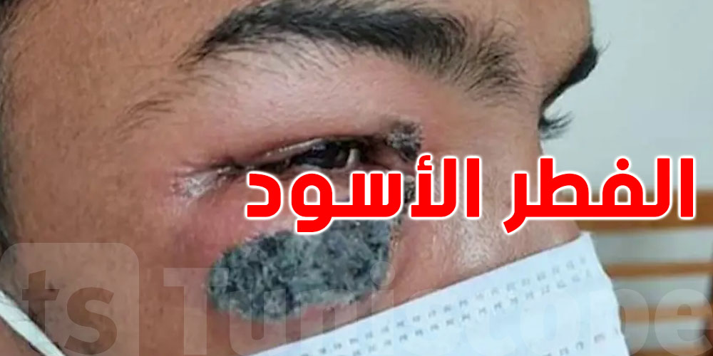 تم تسجيل أول اصابة في تونس: ماهو الفطر الأسود وما علاقته بالكورونا
