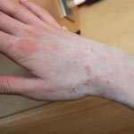 La gale fait ravage dans les établissements scolaires et les foyers 