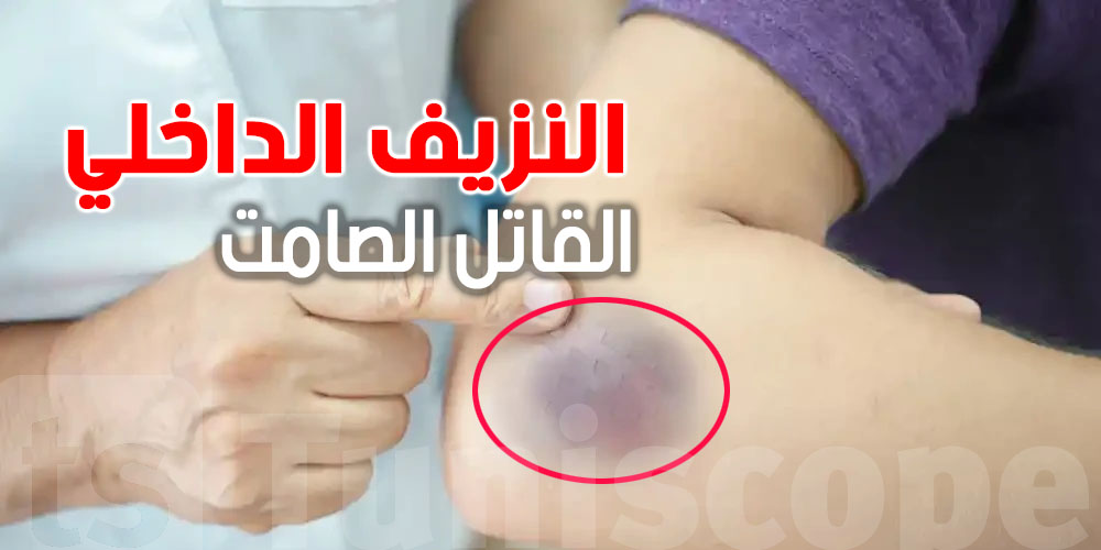 شنّوة علامات وأعراض النزيف الداخلي؟