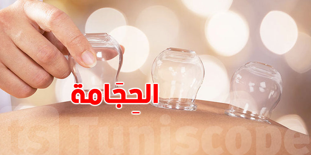 الحِجَامة ليست للجميع… تعرف على الحالات الممنوعة
