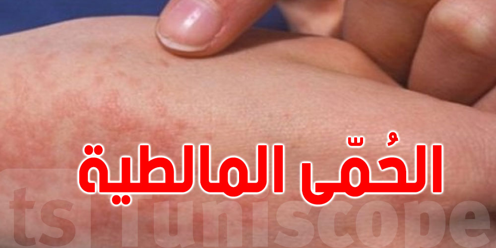 قبلي: ارتفاع عدد حالات الاصابة بالحمى المالطية