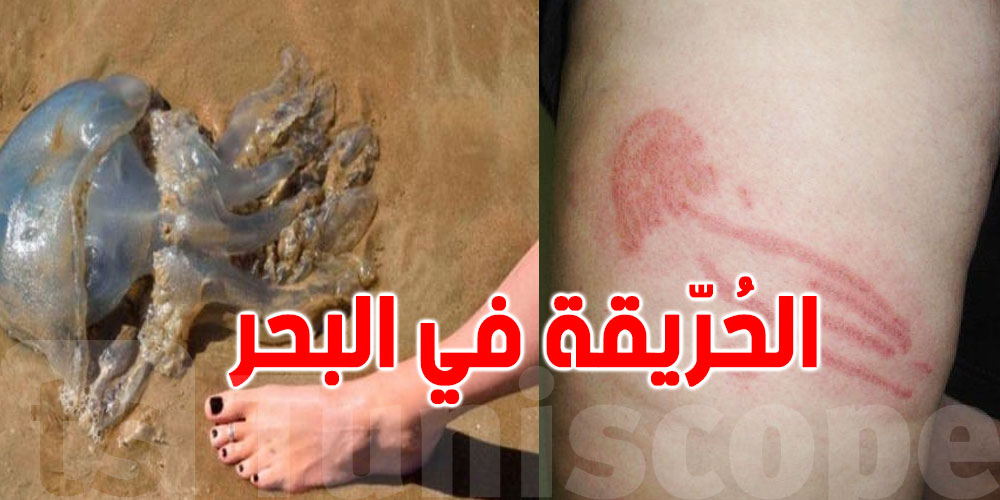 8 خطوات لعلاج لسعات''الحُرّيقة'' في البحر