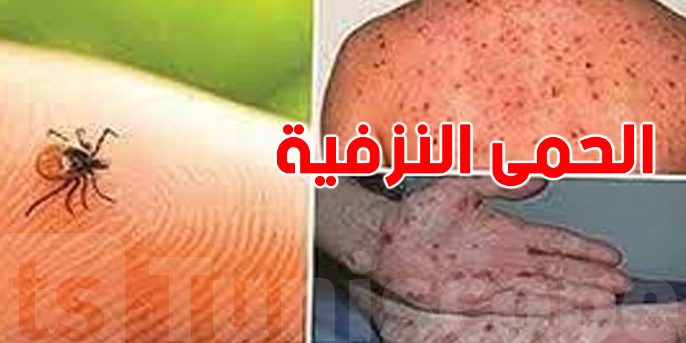 الحمّى النزفية: شنوّة الوضع في العراق؟ 42 وفاة منذ بداية 2025!