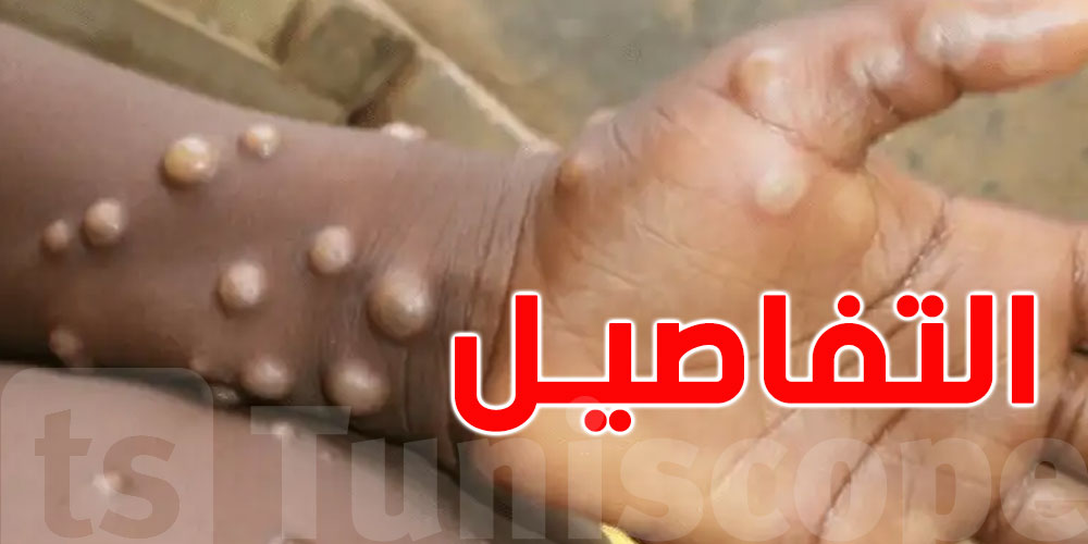 مصر تعلن رصد أول حالة إصابة بجدري القردة
