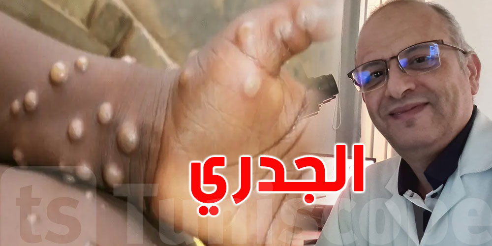 دكتور تونسي يُحذّر من ''الجدري'' ويدعو الى التلقيح ضدّه