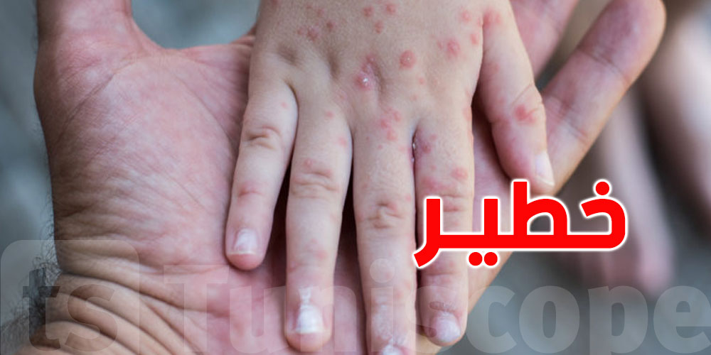 عاجل : جدري القردة : يزوره كثيراً التونسيون .. تسجيل أول إصابة في هذا البلد