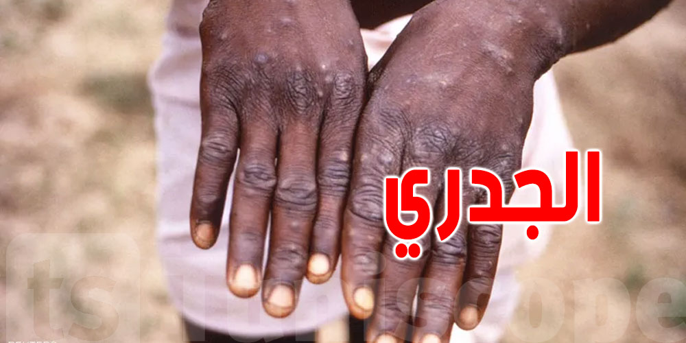 6 نصائح بسيطة كي تحمي نفسك من جدري القردة