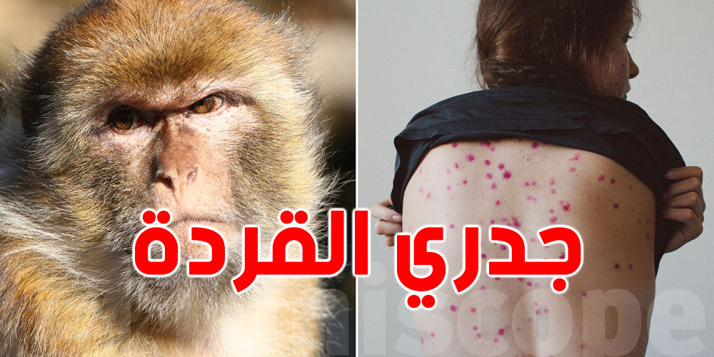 شنيا هو جدري القردة (Mpox)؟ وهل هو مرض معدي؟ وهل ينجم يوصل لتونس؟