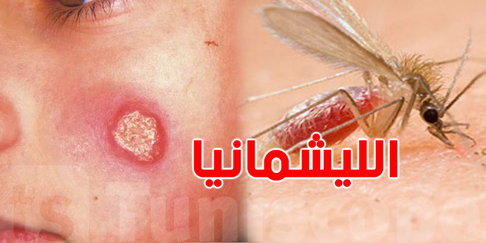 شنيا هو '' داء الليشمانيا'' الي انتشر في تونس؟