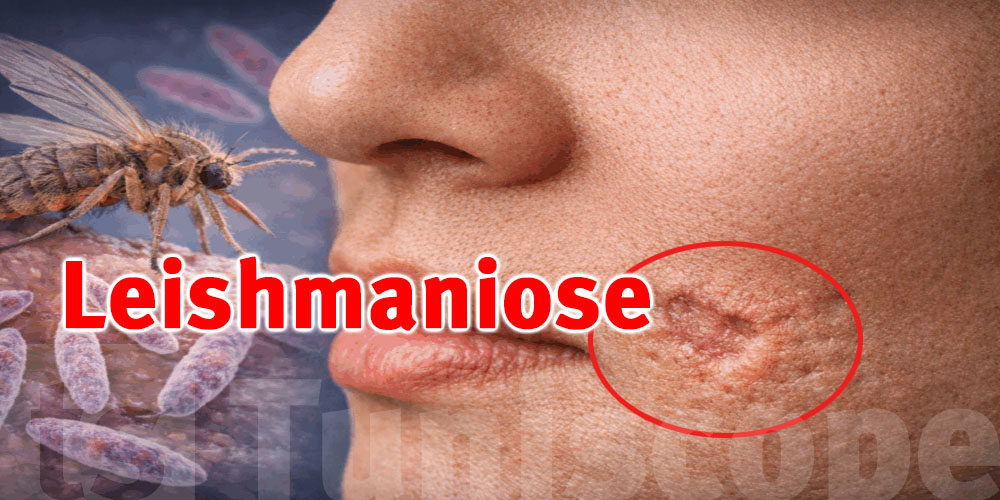 La leishmaniose : qu’est-ce que c’est et comment se protéger