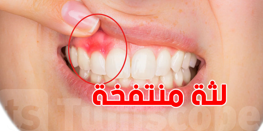 لثة منتفخة؟ الأسباب والنصائح باش تتجنب المشاكل