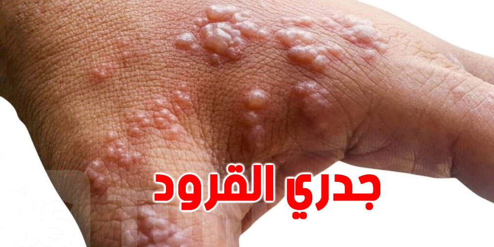  تسجيل أول إصابة بجدري القردة في هذا البلد 