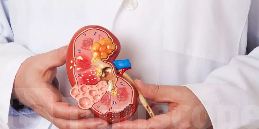 دراسة تكشف السر الخفي لتكوّن حصوات الكلى