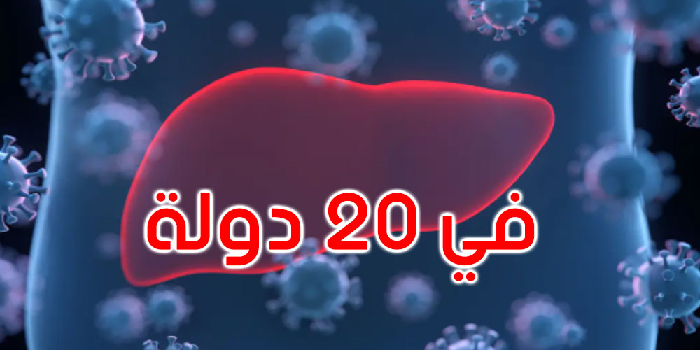 230  إصابة بالتهاب كبدي مجهول في 20 دولة