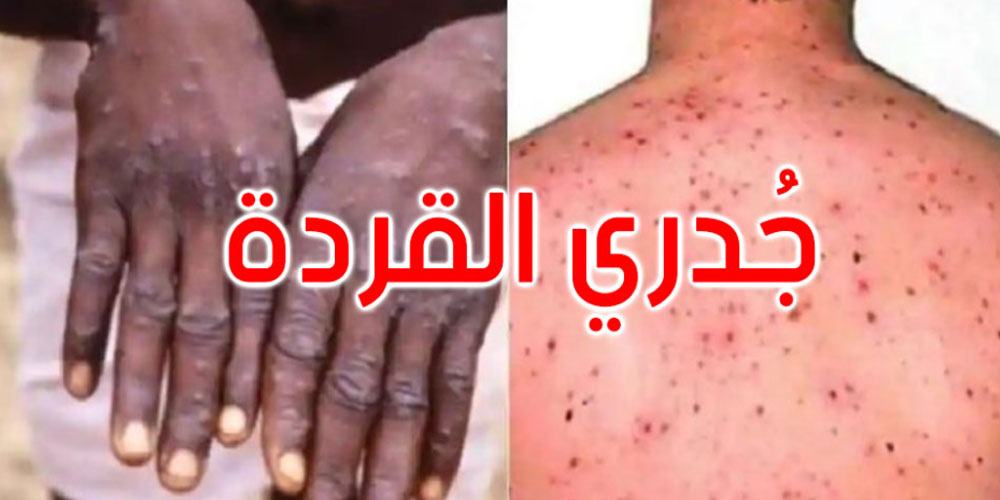 رصد إصابة بجدري القردة لعائد من الخارج في هذا البلد