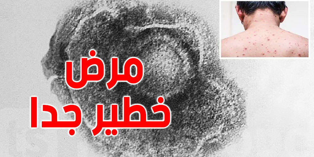 تحذيرات من مرض خطير جدا ينتشر أسرع من فيروس كورونا