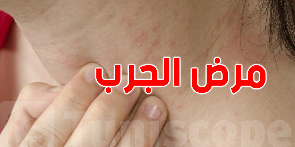 السيطرة على إصابات بمرض الجرب في صفوف تلاميذ في هذه المنطقة