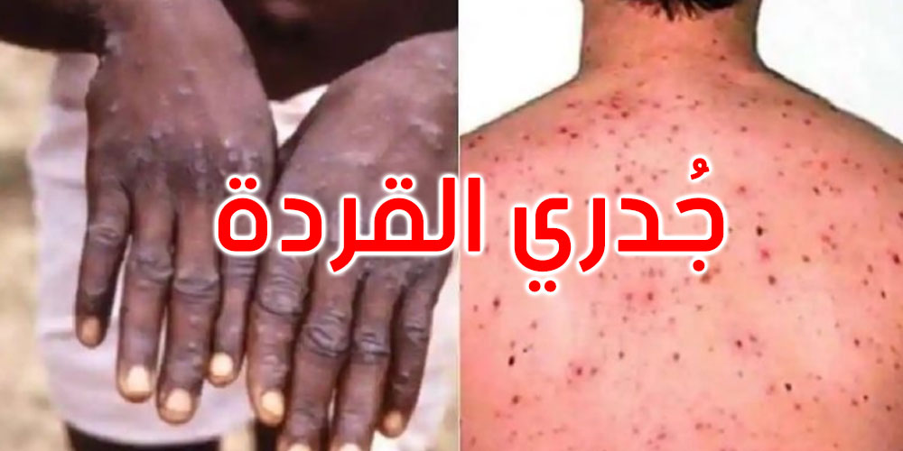 هل تم التبليغ عن إصابة بجدري القردة في تونس ؟ العوني يجيب