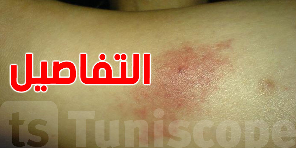 مرض الليشمانيا في تونس: طرق الوقاية منه