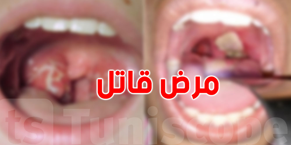 عاجل: حالة طوارئ صحية في الجزائر...وفيات وإصابات بـ''الدفتيريا'' تثير الذعر!
