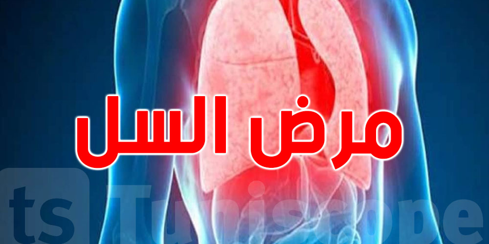 مرض السّل : وزارة الصحة تكشف هذه المعطيات