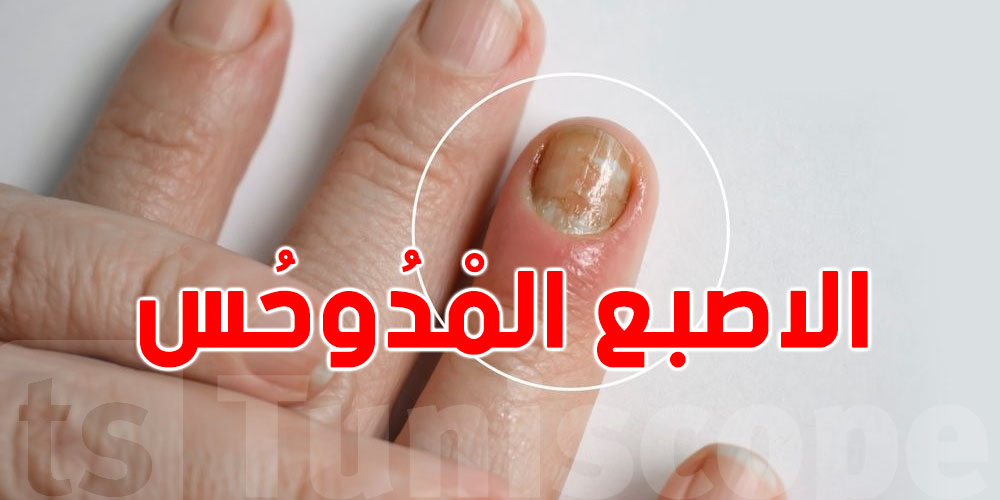 الاصبع المدُوحِسِْ: أعراضه وأنواعه وطرق العلاج الفعّالة