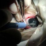 مدنين..فتاة تستعيد بصرها بعد 26 سنة