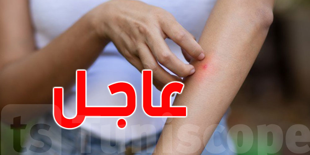 عاجل: تسجيل إصابة بحمى غرب النيل في سوسة