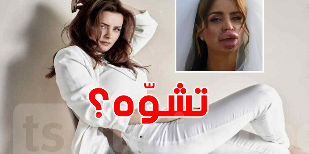 تشوه وجه الفنانة ''نور'' بسبب طبيب التجميل ''نبيل''