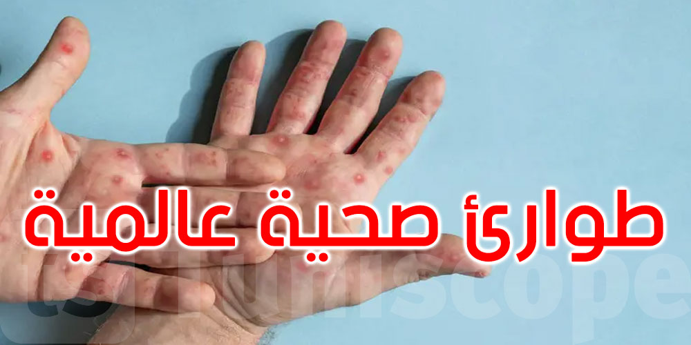للتصدي لجدري القردة.. اجتماع طارئ لمنظمة الصحة العالمية