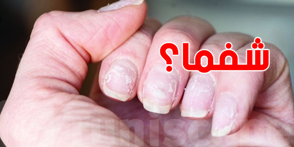 هشاشة الأظافر: مشكلة جمالية أم مؤشر صحي خطير؟